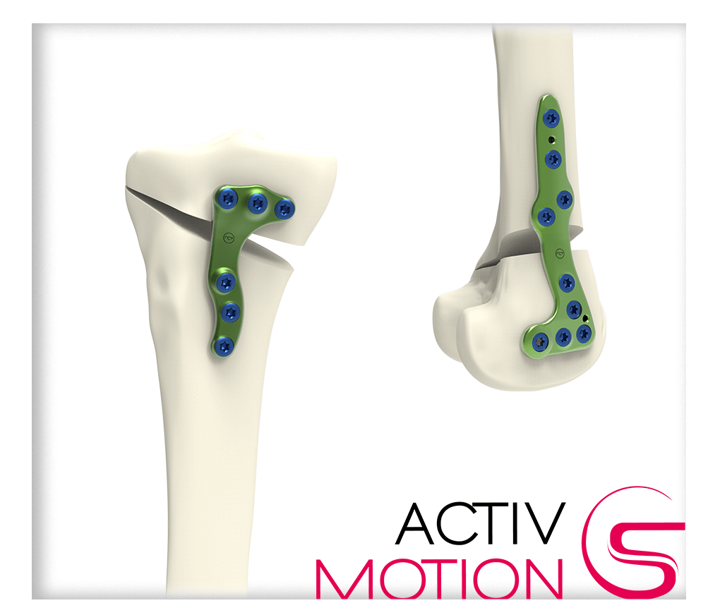 Les Différentes Ostéotomies – Ostéotomie Anatomie – JVENM