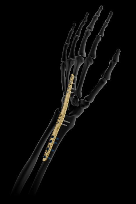 visuels plaques Spanning Poignet